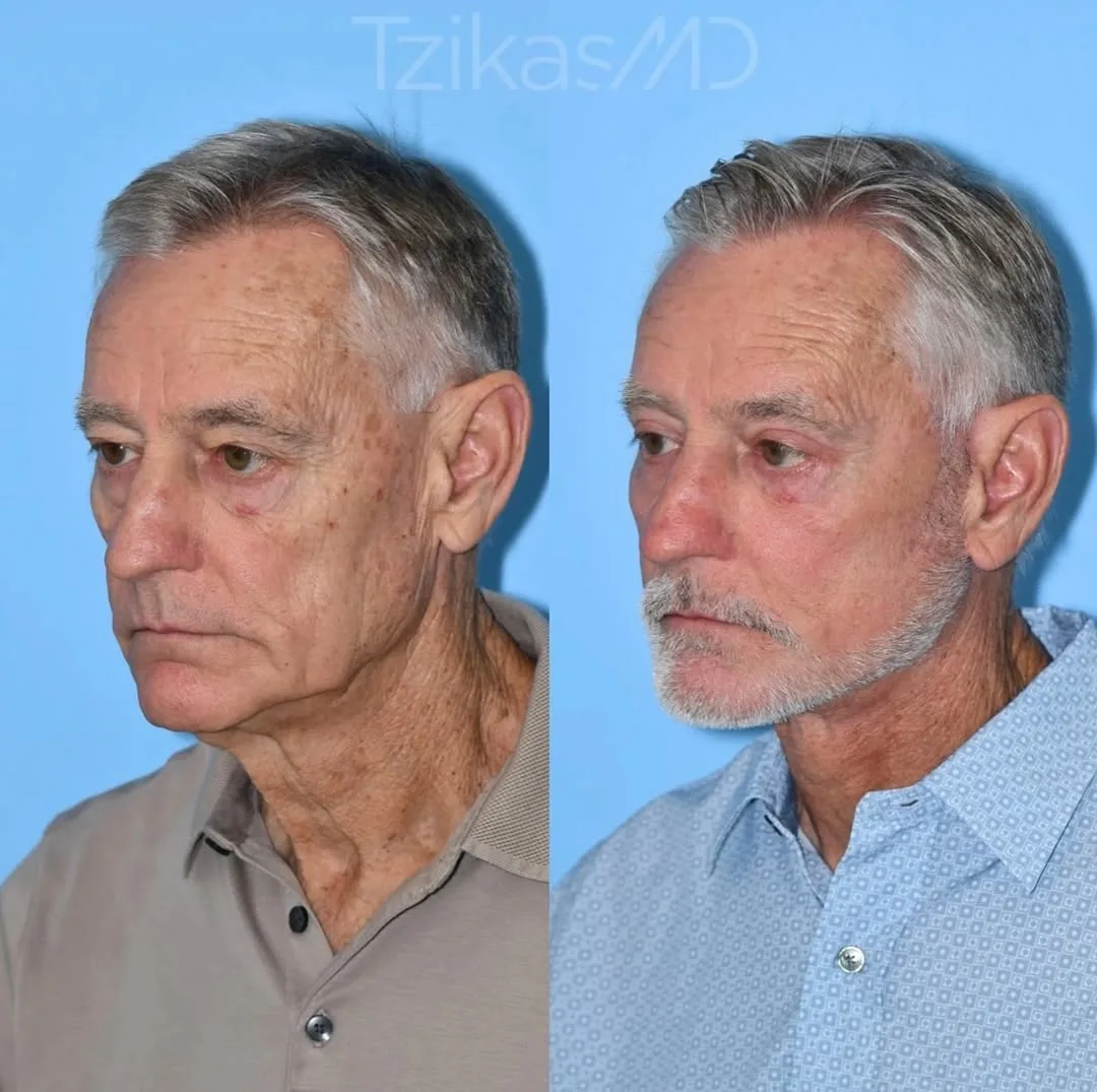 Before and after — Dr. Thomas Tzikas