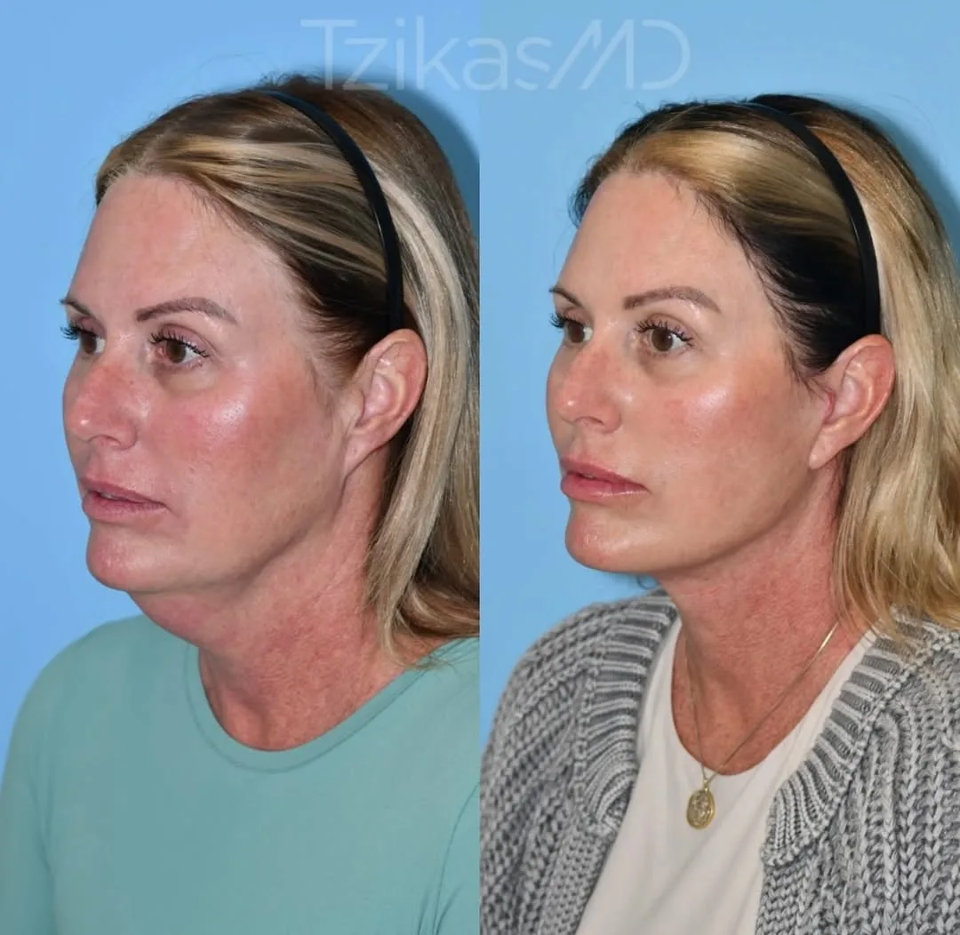 Before and after — Dr. Thomas Tzikas