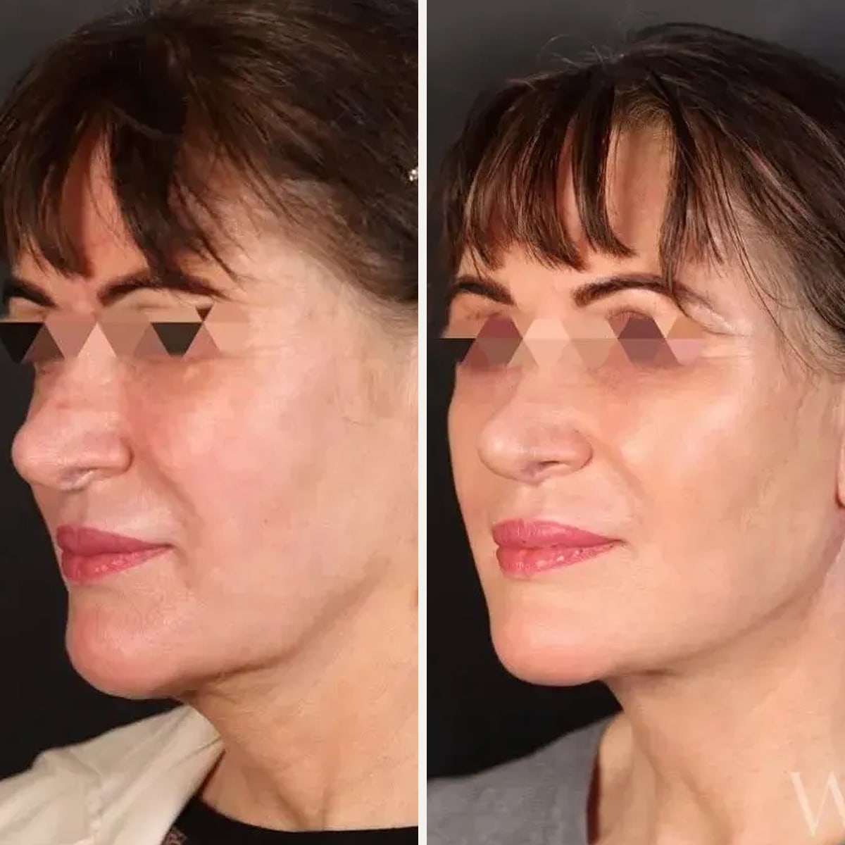 Before and after: Dr. Tim J. Janssen