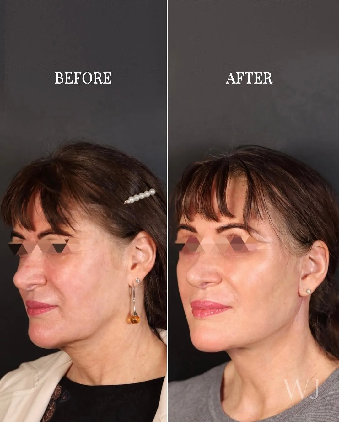 Before and after — Dr. Tim J. Janssen