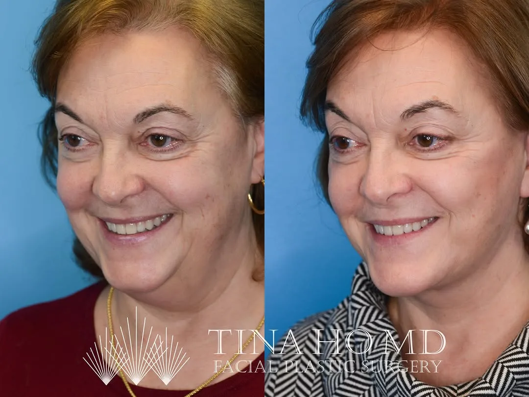 Before and after — Dr. Tina Ho