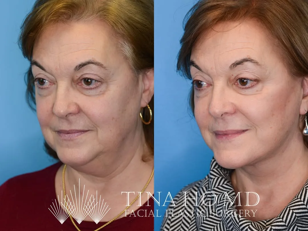 Before and after — Dr. Tina Ho