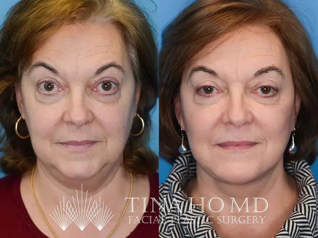 Before and after — Dr. Tina Ho