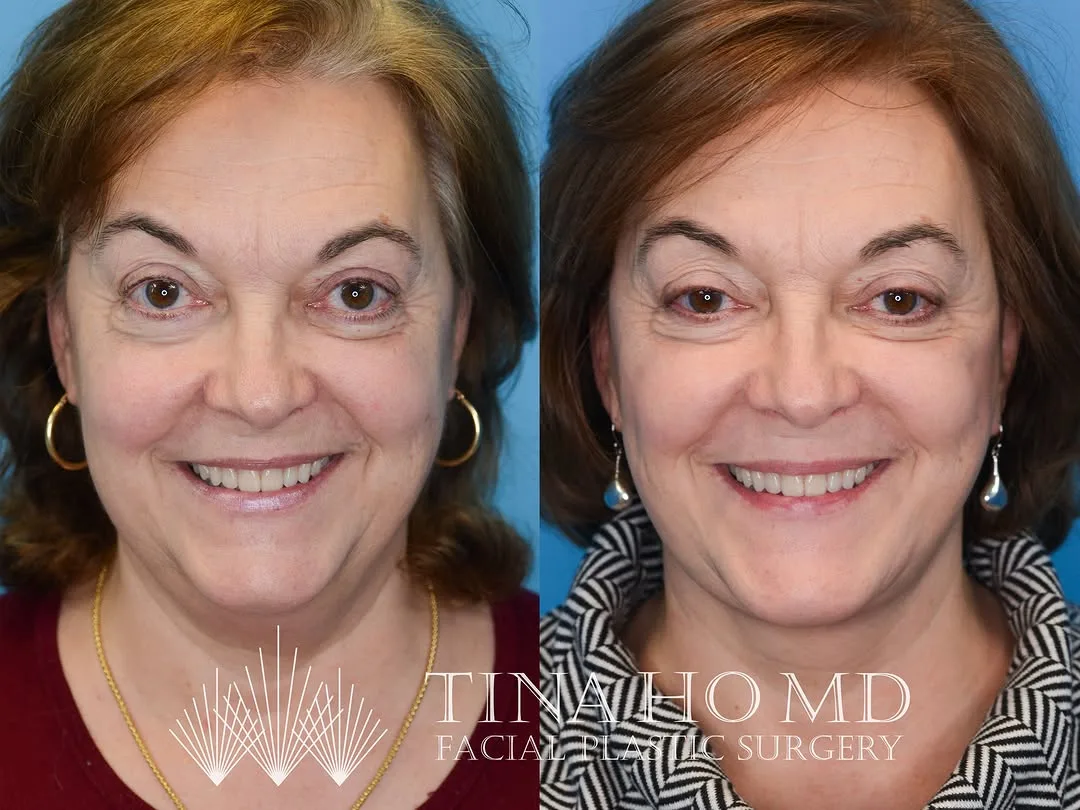 Before and after — Dr. Tina Ho