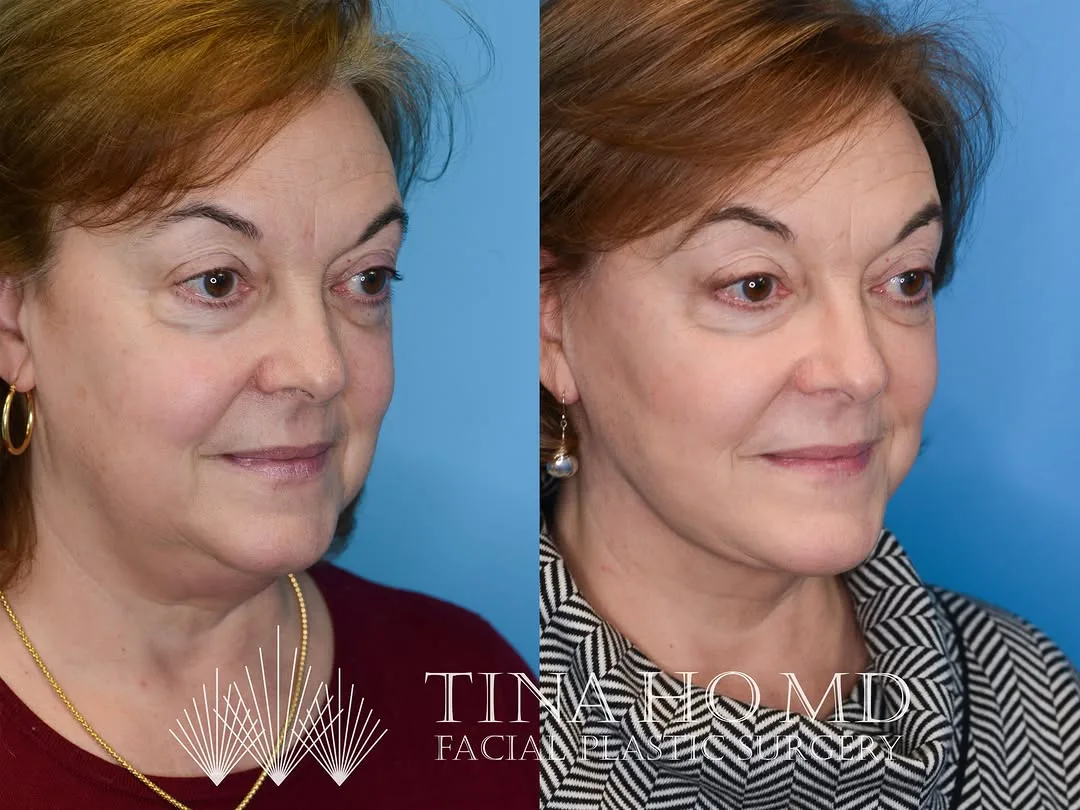 Before and after — Dr. Tina Ho