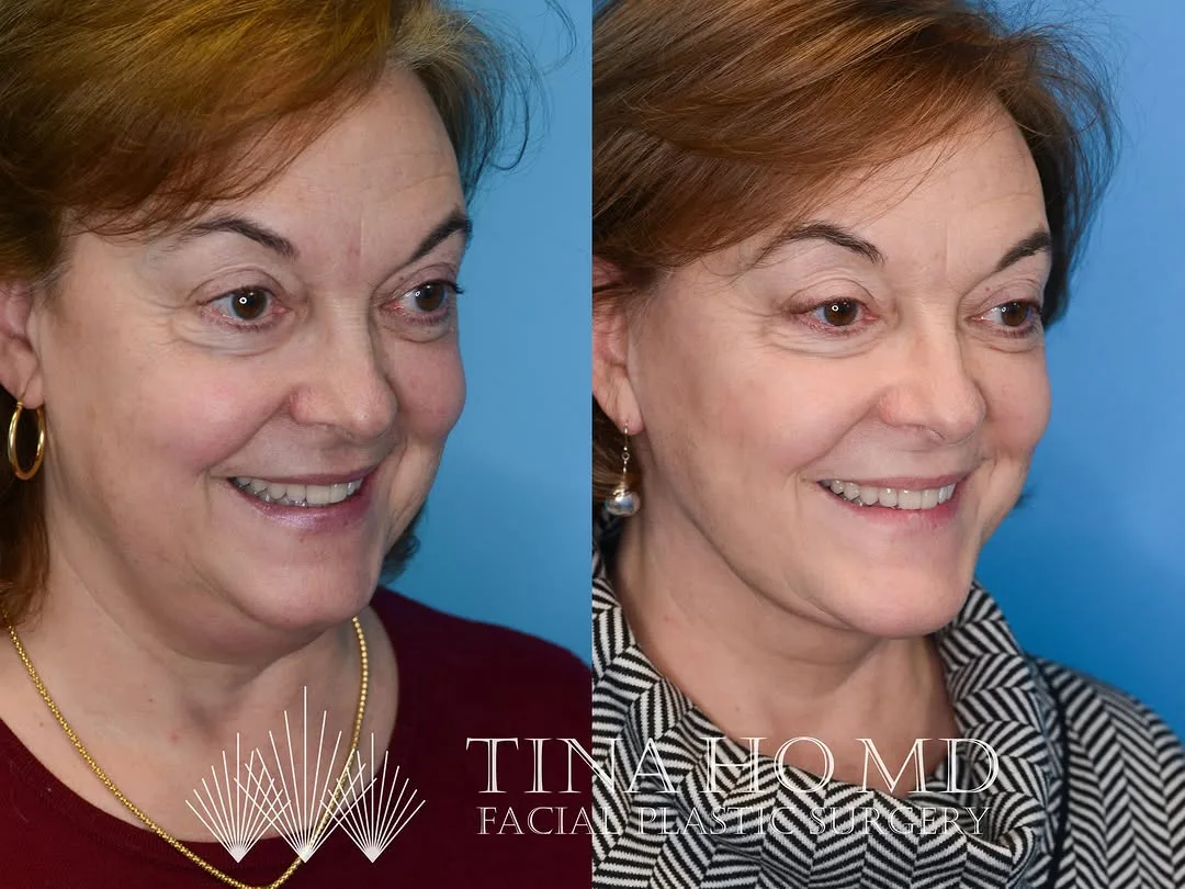 Before and after — Dr. Tina Ho