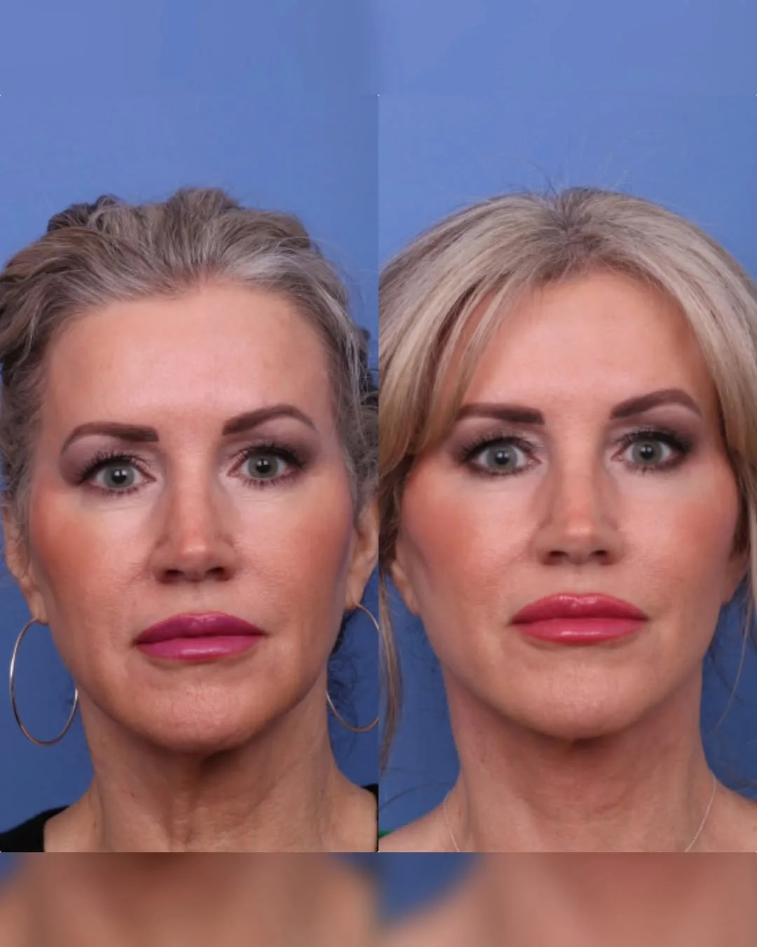 Before and after — Dr. Todd Hobgood