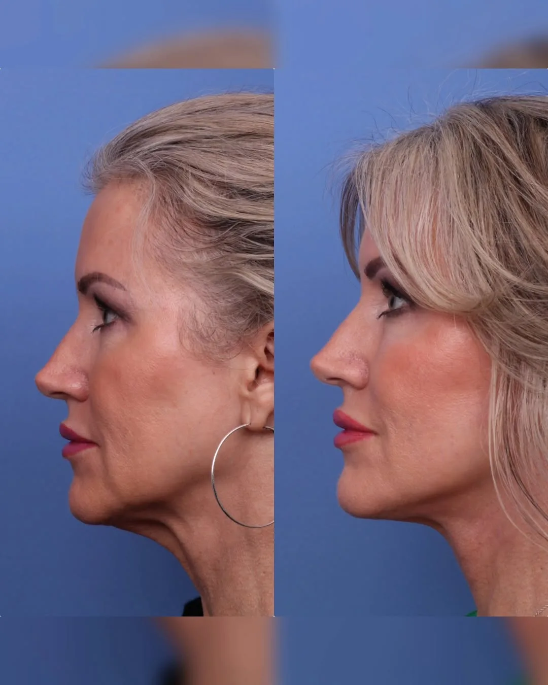 Before and after — Dr. Todd Hobgood