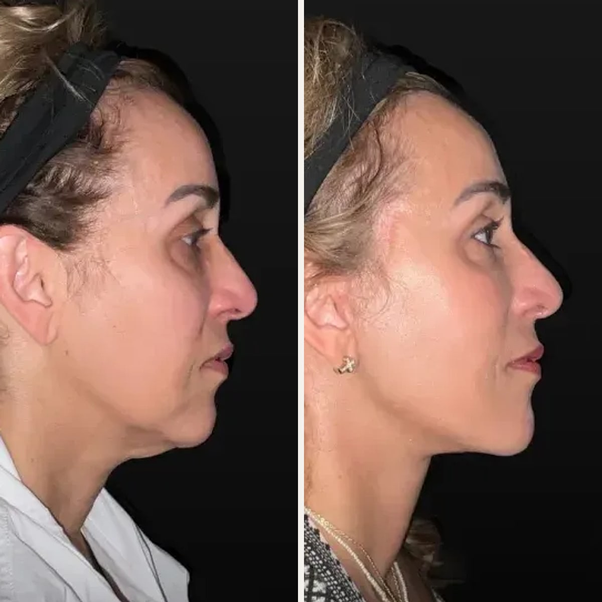 До и после — Deep Plane Facelift от доктора Todd Lefkowitz