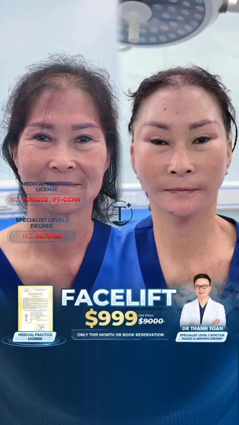 قبل وبعد - Deep Plane Facelift بواسطة د. Tran Thanh Toan