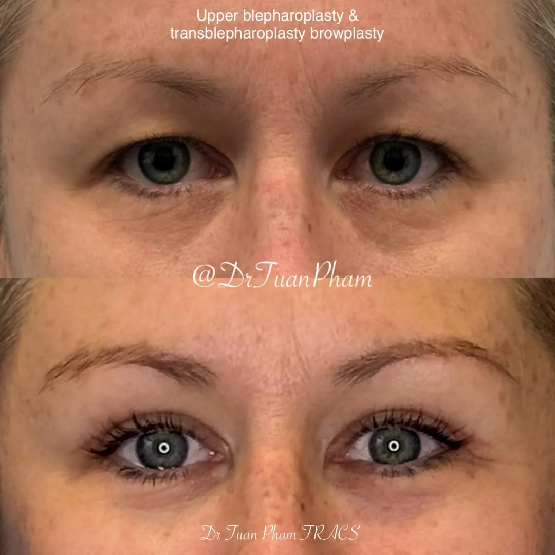 Before and after deep plane facelift — 52-year-old woman, frontal view, 2mo post-op by Dr. Tuan Pham