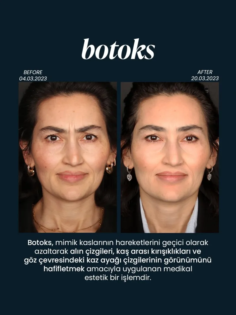 Before and after — Dr. Tuba Hilal Güçlü