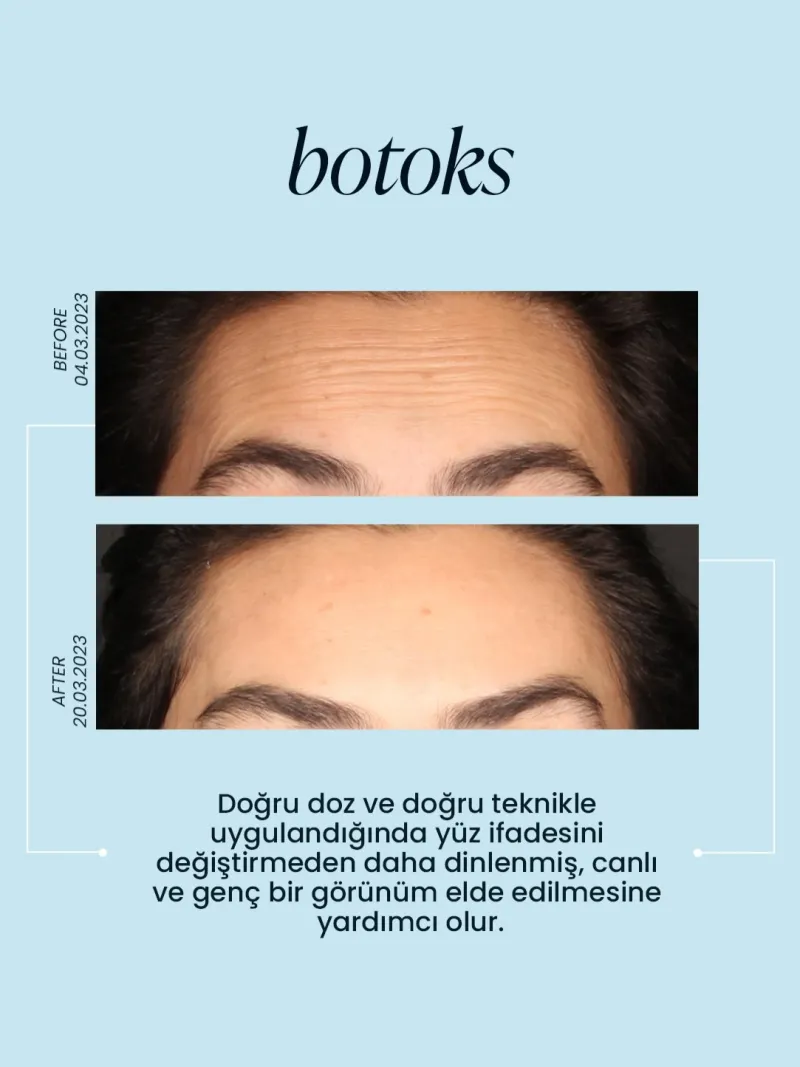 Before and after — Dr. Tuba Hilal Güçlü