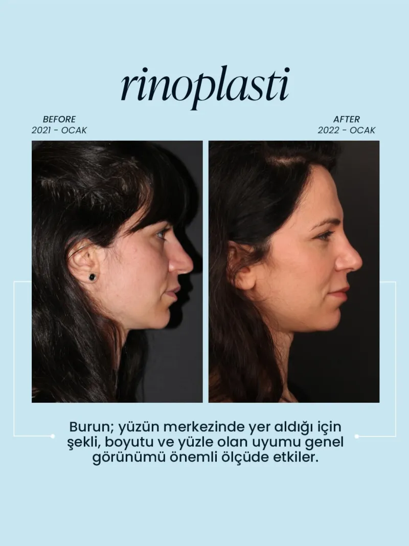Before and after — Dr. Tuba Hilal Güçlü