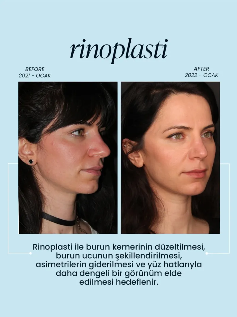 Before and after — Dr. Tuba Hilal Güçlü