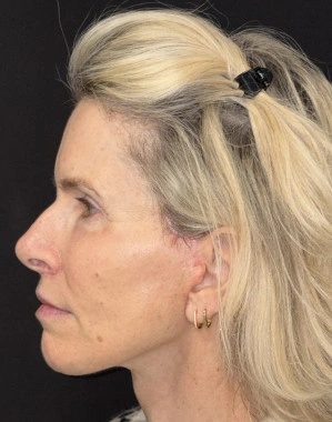 Before and after: Dr. Tunç Tiryaki