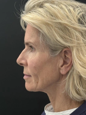 Before and after — Dr. Tunç Tiryaki