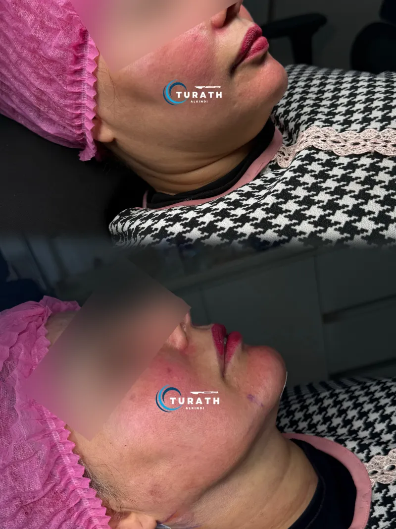 До и после — Deep Plane Facelift от доктора Turath Alkindi
