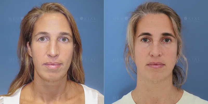 Before and after deep plane facelift — 50-year-old woman, frontal view, 6mo post-op by Dr. Tyler McElwee