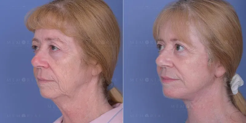 Before and after deep plane facelift — 60-year-old woman, left profile view, 6mo post-op by Dr. Tyler McElwee