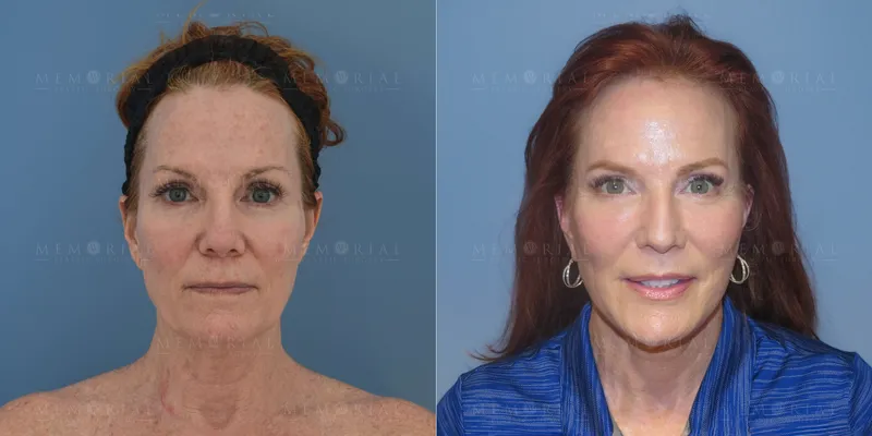 Before and after deep plane facelift — 55-year-old woman, frontal view, 6mo post-op by Dr. Tyler McElwee