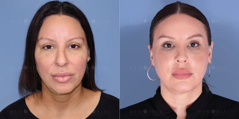 Before and after deep plane facelift — 50-year-old woman, frontal view, 6mo post-op by Dr. Tyler McElwee