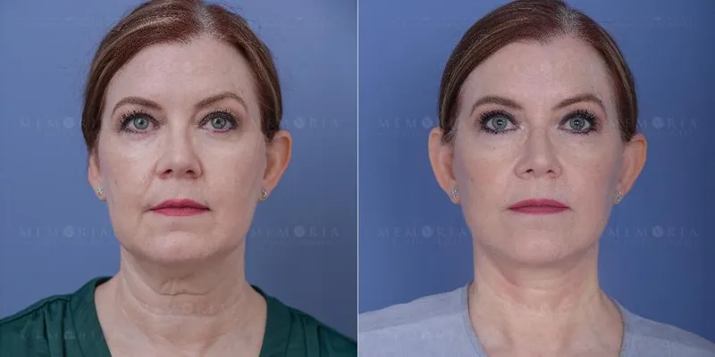 Before and after deep plane facelift — 55-year-old woman, frontal view, 6mo post-op by Dr. Tyler McElwee