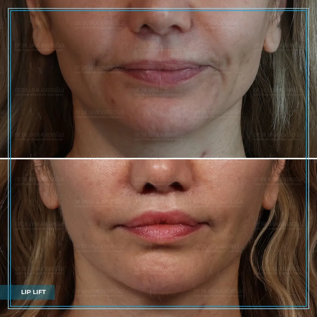 Before and after deep plane facelift — 45-year-old woman, frontal view, 6mo post-op by Dr. Ufuk Askeroglu