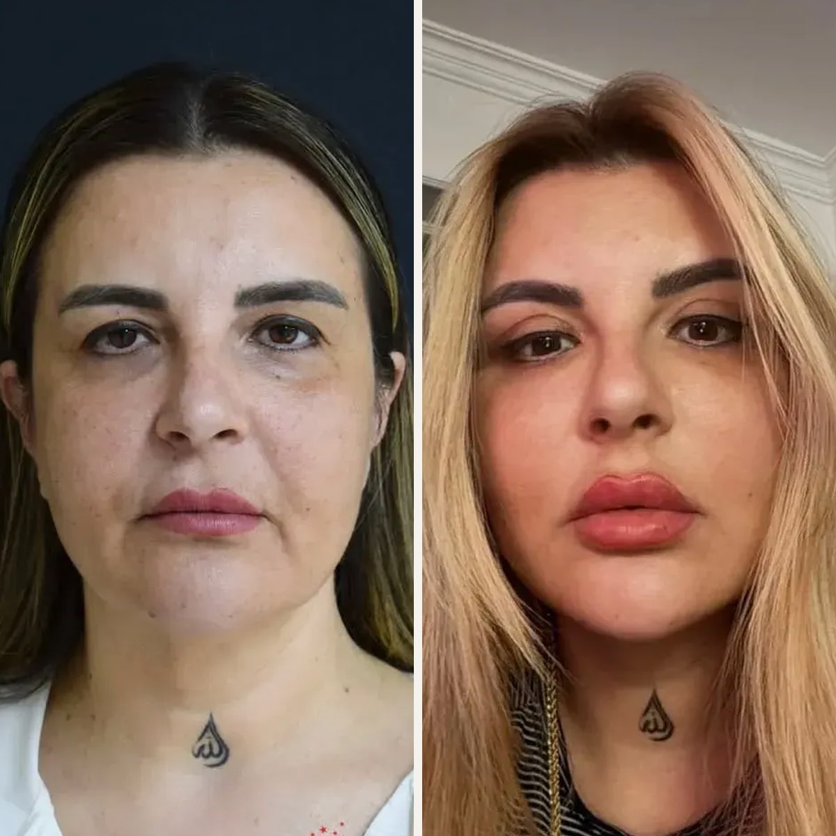 Before and after: Dr. Ufuk Bilkay