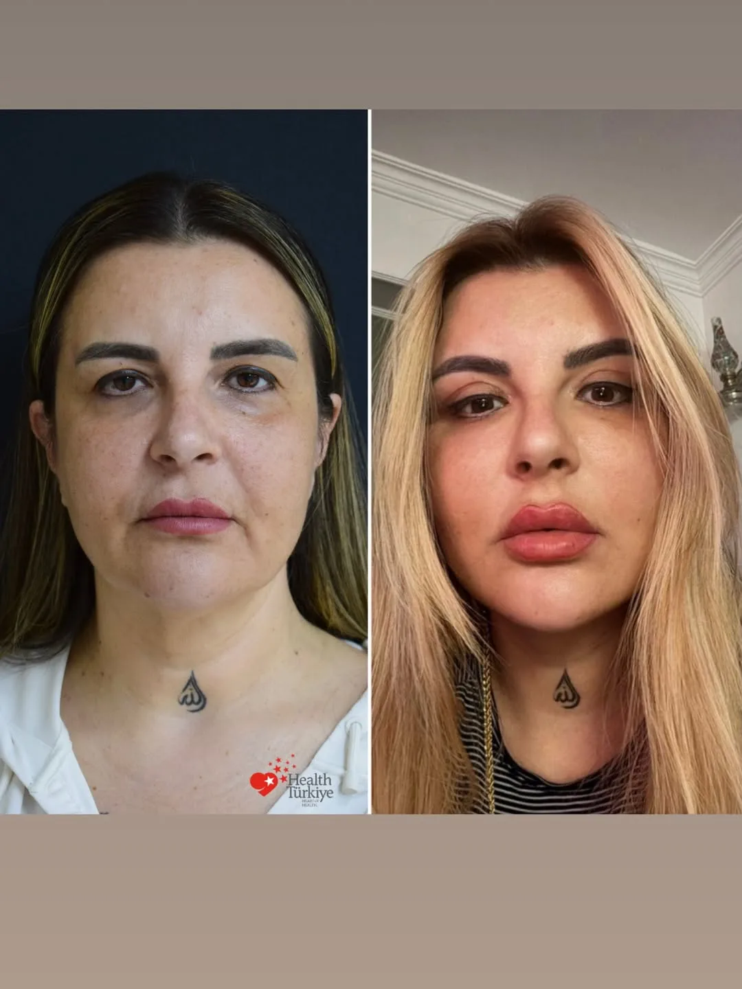 Before and after deep plane facelift — 38-year-old woman, frontal view, 6mo post-op by Dr. Ufuk Bilkay