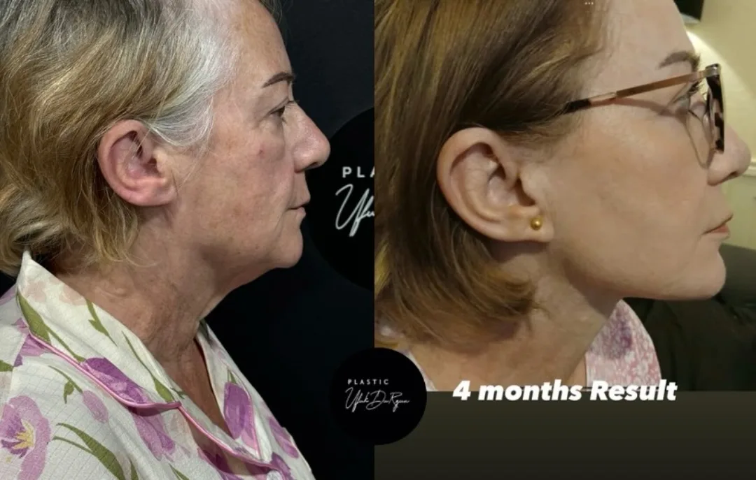 Before and after deep plane facelift — 68-year-old woman, right profile view, 4mo post-op by Dr. Ufuk Durgun