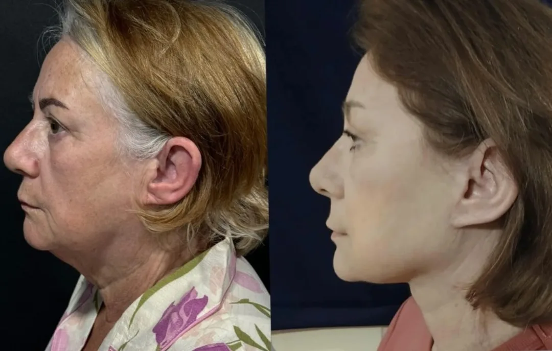 Before and after deep plane facelift — 58-year-old woman, right profile view, 6mo post-op by Dr. Ufuk Durgun