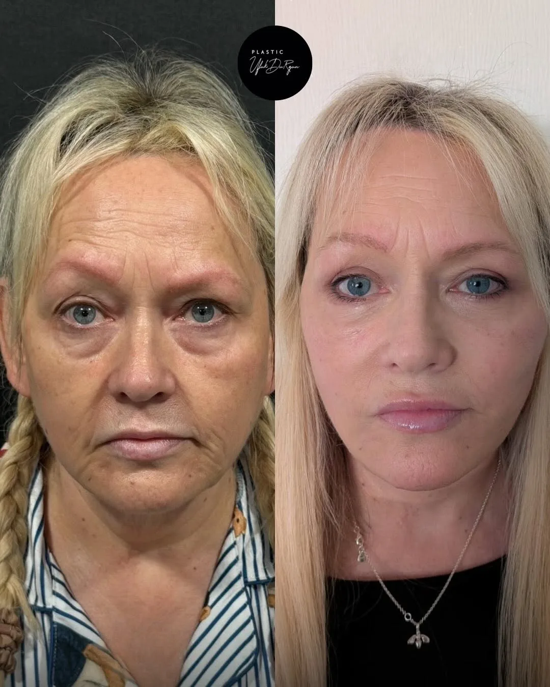Before and after deep plane facelift — 55-year-old woman, frontal view, 7mo post-op by Dr. Ufuk Durgun