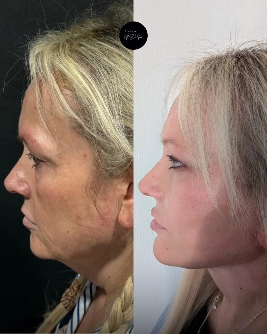 Before and after deep plane facelift — 55-year-old woman, right profile view, 6mo post-op by Dr. Ufuk Durgun