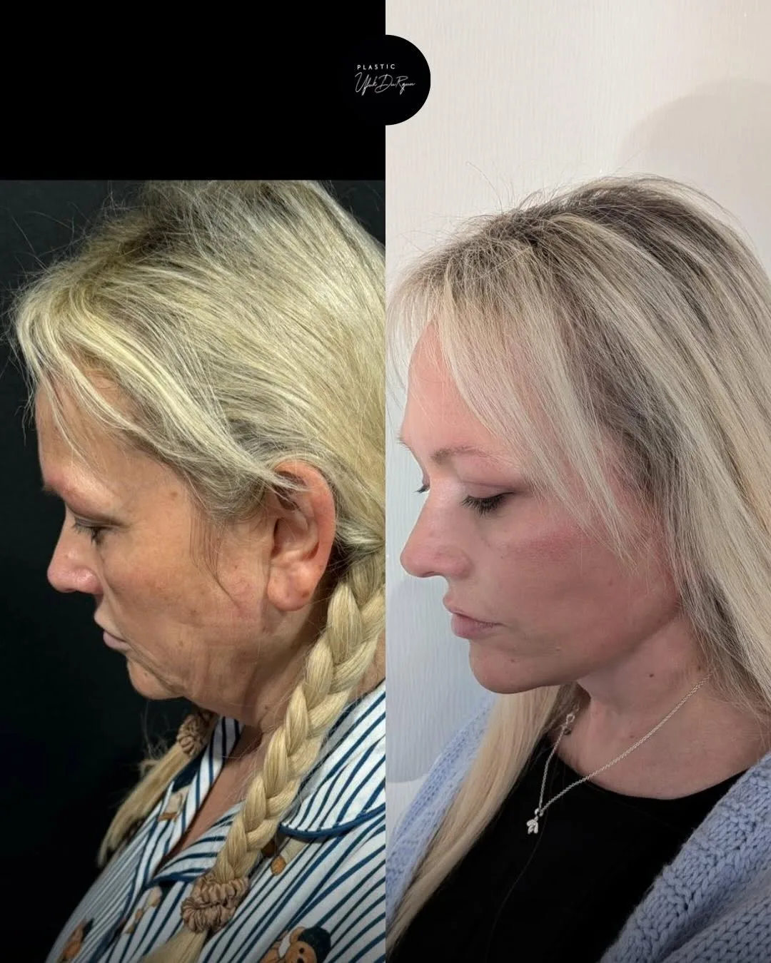 Before and after deep plane facelift — 58-year-old woman, right profile view, 8mo post-op by Dr. Ufuk Durgun