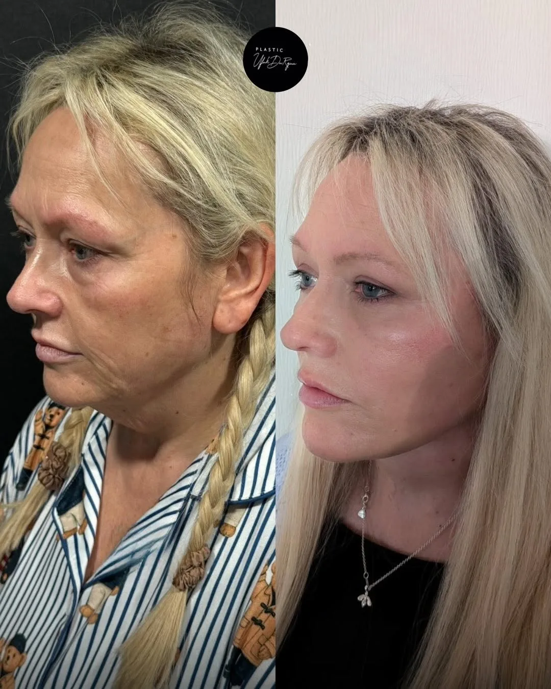 Before and after deep plane facelift — 52-year-old woman, left profile view, 6mo post-op by Dr. Ufuk Durgun
