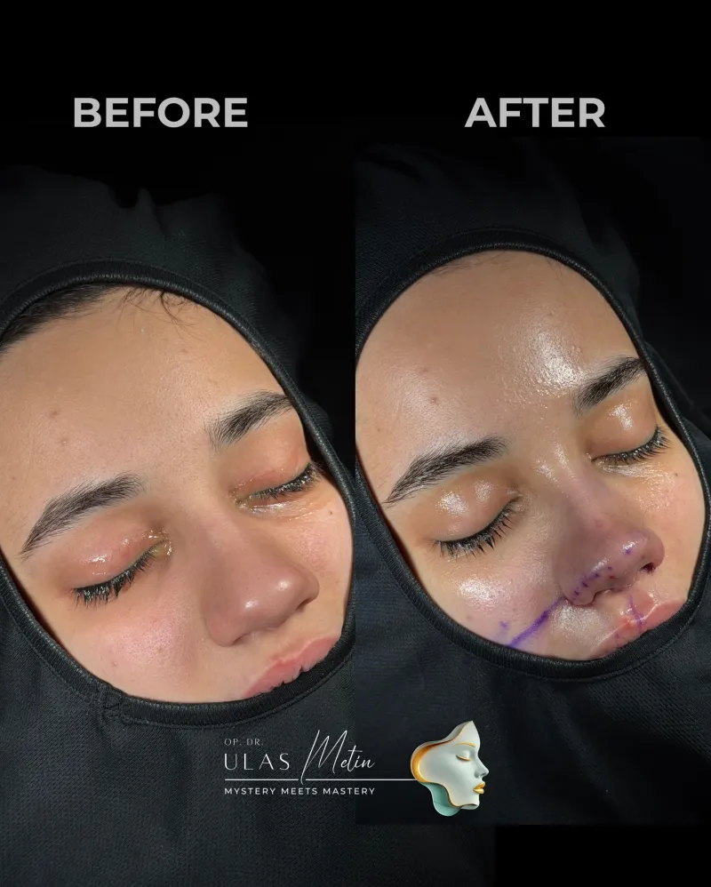 Before and after — Dr. Ulaş Metin