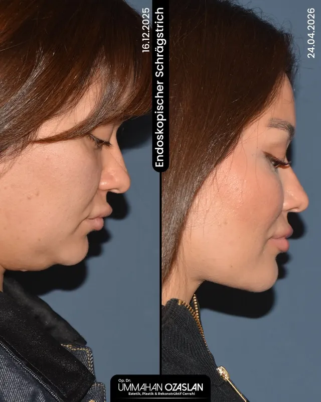 Before and after deep plane facelift — -1-year-old patient, frontal view by Dr. Ümmühan Özaslan