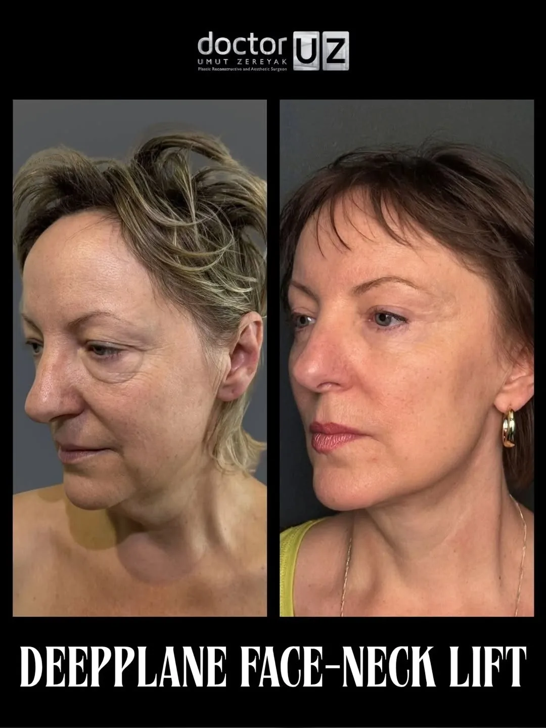 Before and after — Dr. Umut Zereyak