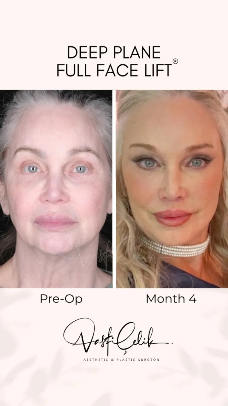 Before and after — Dr. Vasfi Çelik