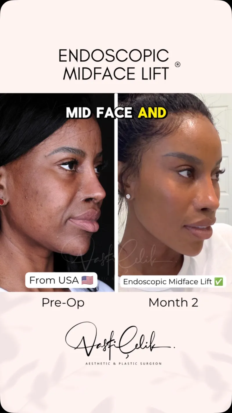 Before and after — Dr. Vasfi Çelik