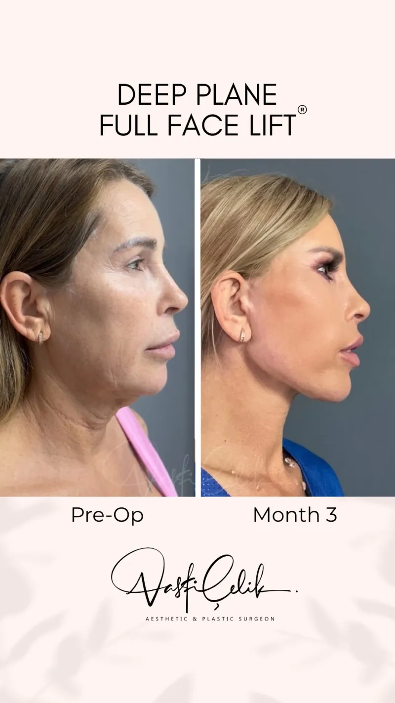 Before and after — Dr. Vasfi Çelik