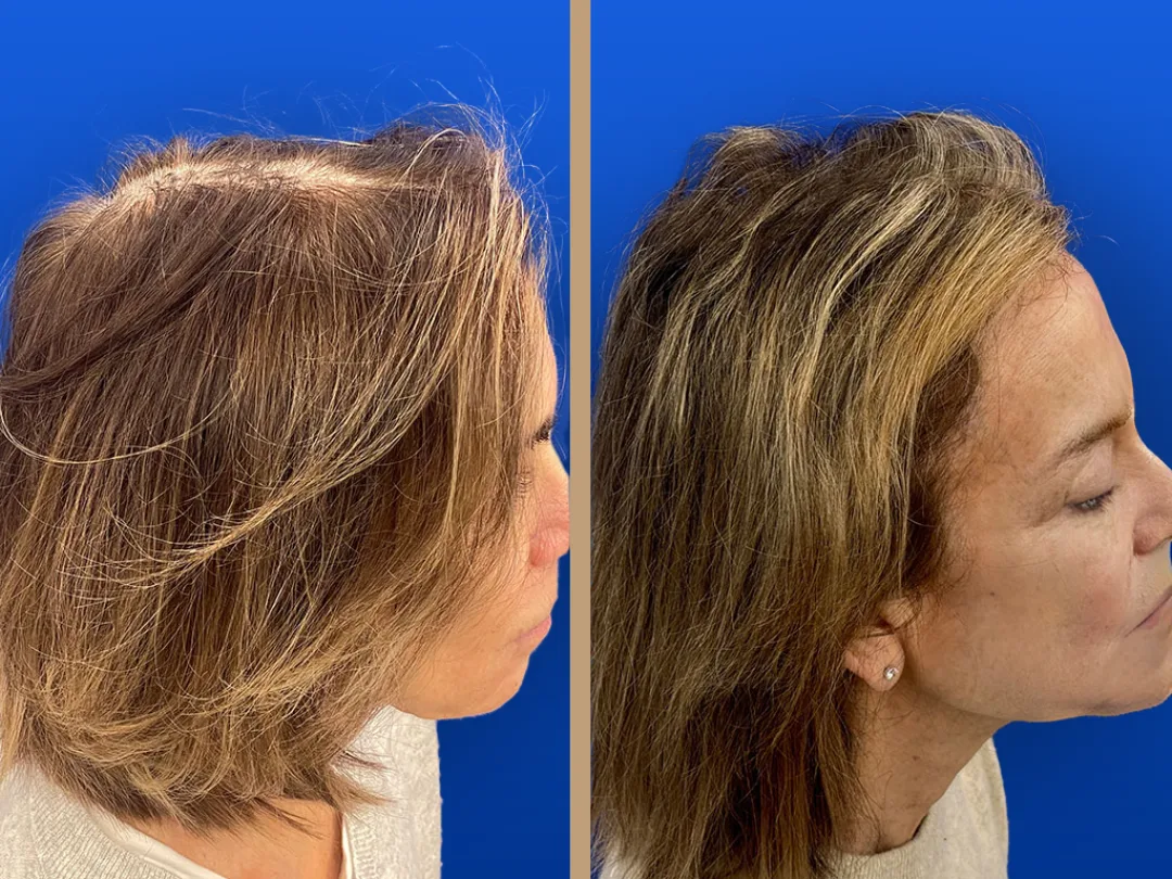 До и после — Temporal Lift от доктора Vinay Rawlani