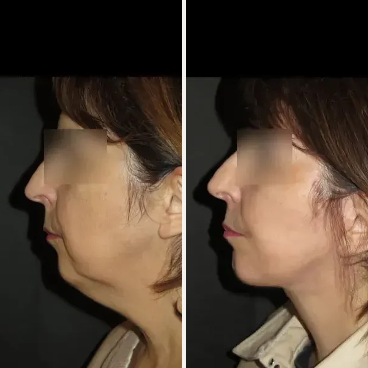 Before and after: Dr. Vincent Nguyen