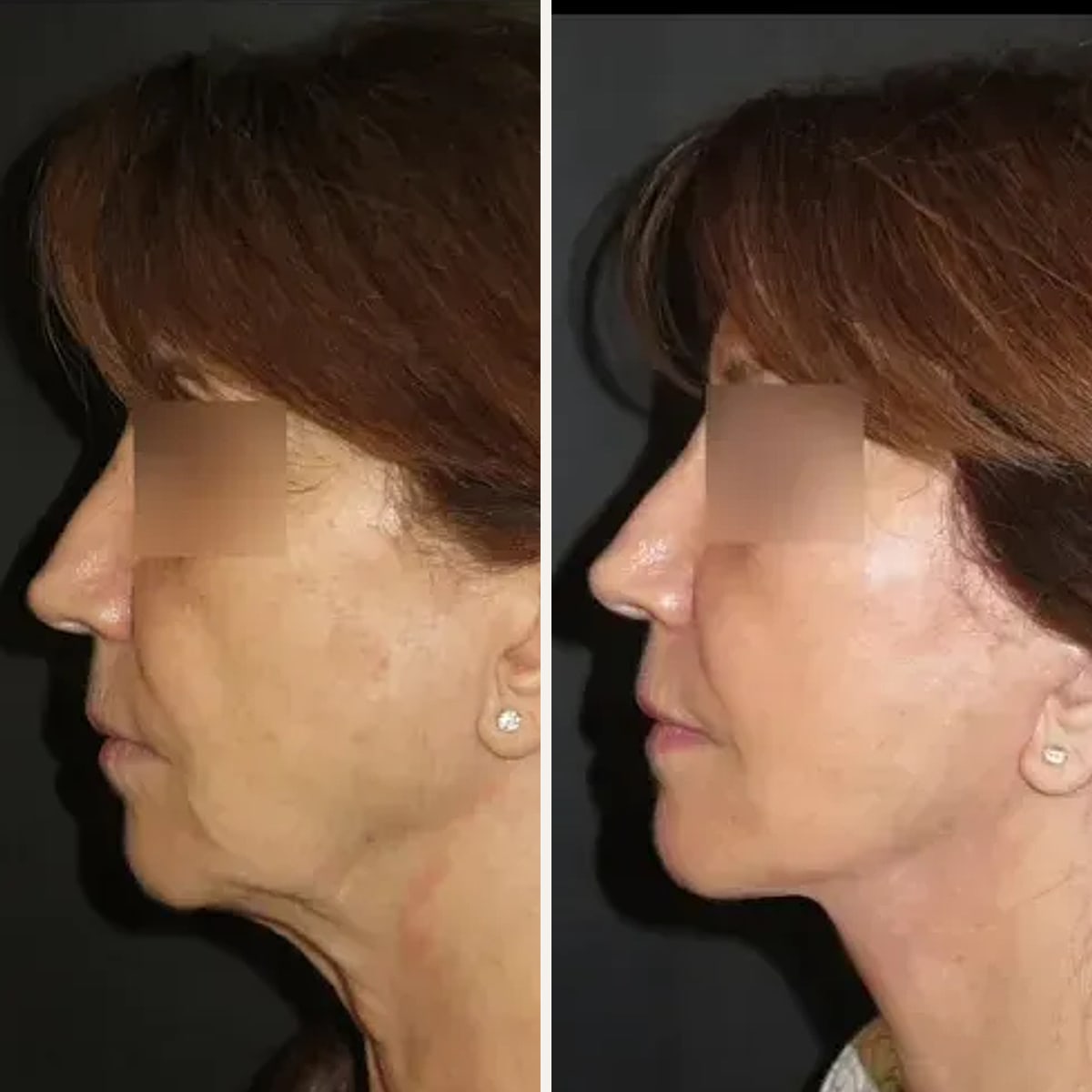 Before and after: Dr. Vincent Nguyen