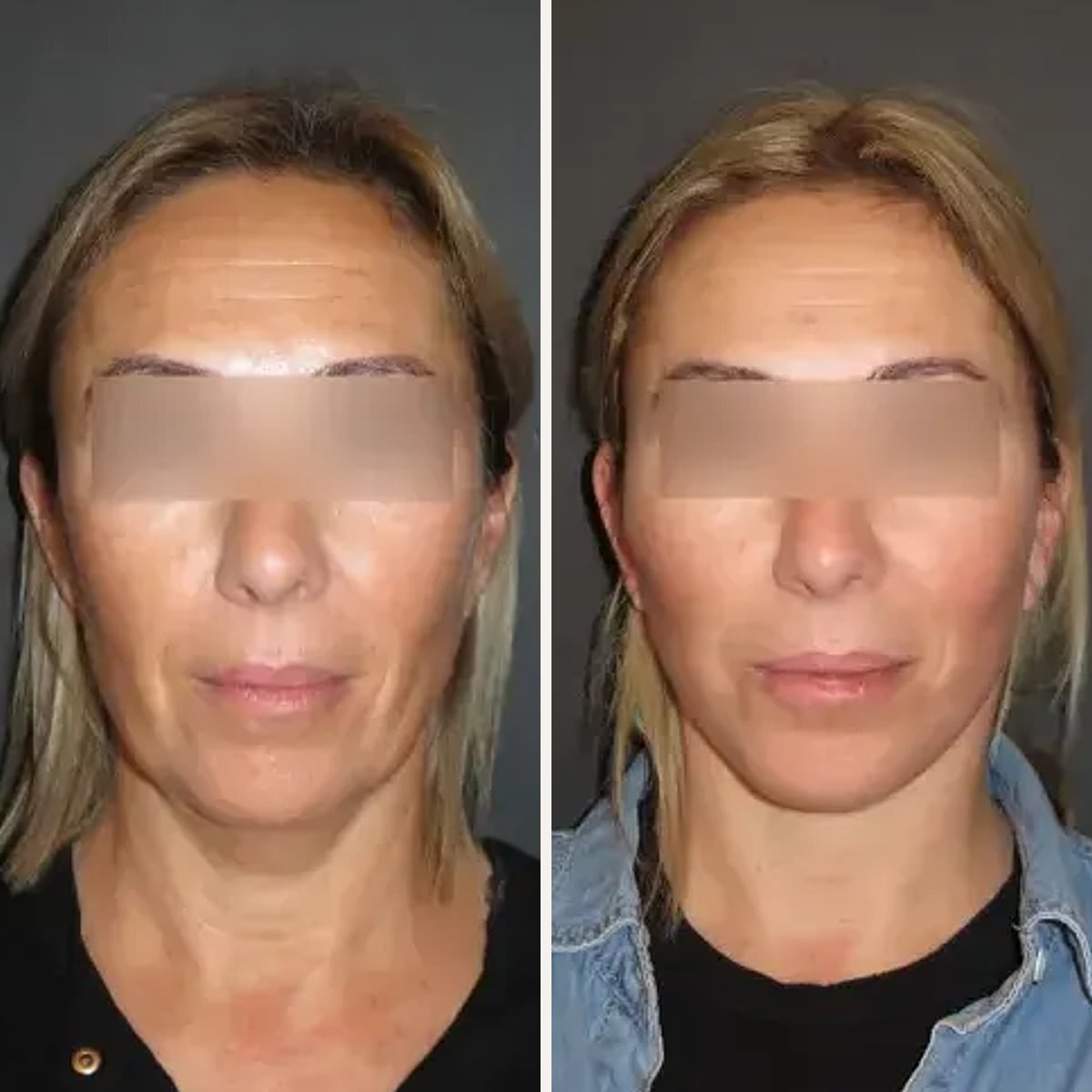 Before and after: Dr. Vincent Nguyen