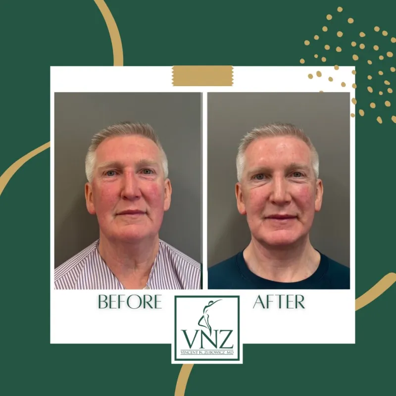 Before and after: Dr. Vincent Zubowicz