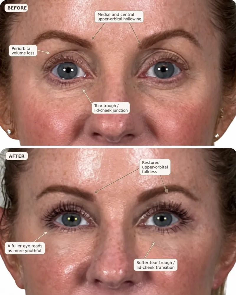 قبل وبعد - Facial Fat Transfer بواسطة د. Vipul Gargya