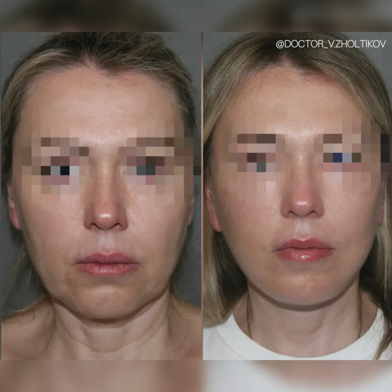 Before and after: Dr. Виталий Жолтиков