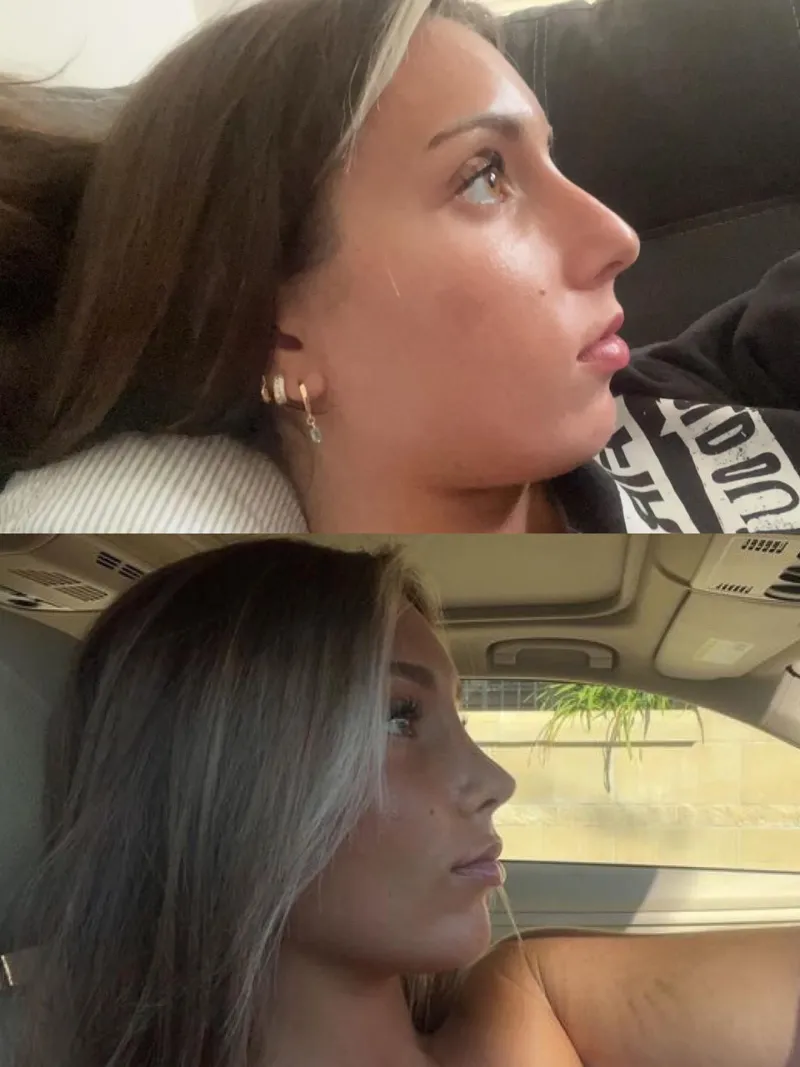 Before and after — Dr. Vito Quatela